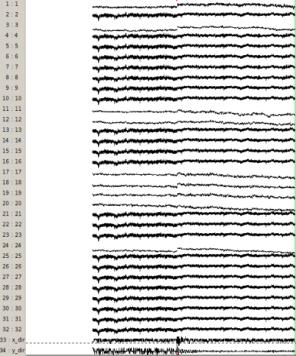 Figure 3.10 : données EEG brutes