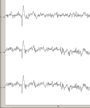Figure 3.13 : données EEG à la fin du prétraitement